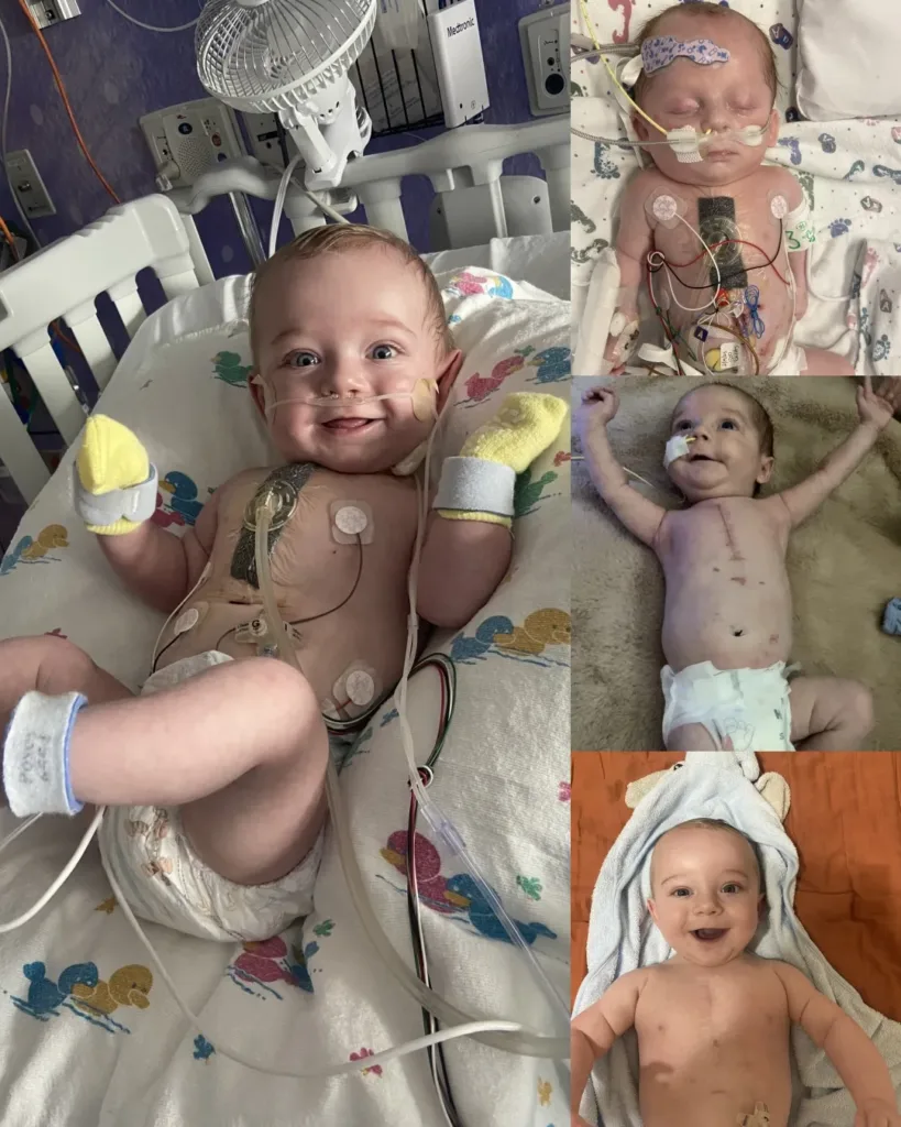 Myles: A Six-Month-Old Warrior's Journey with HLHS and AVSD Myles: A Six-Month-Old Warrior's Journey with HLHS and AVSD